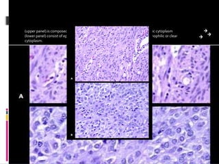 (upper panel) is composed of spindle cells with elongated nuclei and eosinophilic cytoplasm (lower panel) consist of epithelioid cells having round central nuclei within eosinophilic or clear cytoplasm. 
