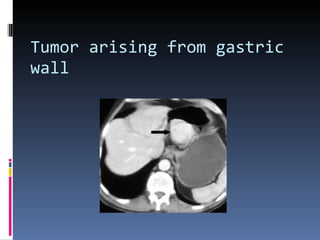 Tumor arising from gastric wall  