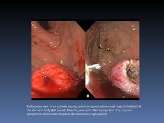Endoscopic view  of an actively oozing 20mm by 30mm submucosal mass in the body of the stomach body (left panel). Bleeding was controlled by injection of a 1:10,000 epiniphrine solution and bioploar electrocautery (right panel).  