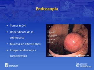 Endoscopía
• Tumor móvil
• Dependiente de la
submucosa
• Mucosa sin alteraciones
• Imagen endoscópica
característica
 