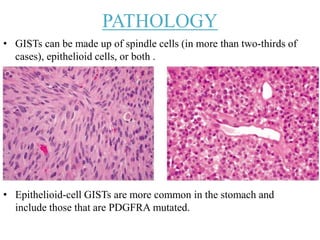 PATHOLOGY
• GISTs can be made up of spindle cells (in more than two-thirds of
cases), epithelioid cells, or both .
• Epithelioid-cell GISTs are more common in the stomach and
include those that are PDGFRA mutated.
 
