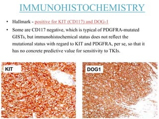 IMMUNOHISTOCHEMISTRY
• Hallmark - positive for KIT (CD117) and DOG-1
• Some are CD117 negative, which is typical of PDGFRA-mutated
GISTs, but immunohistochemical status does not reflect the
mutational status with regard to KIT and PDGFRA, per se, so that it
has no concrete predictive value for sensitivity to TKIs.
 