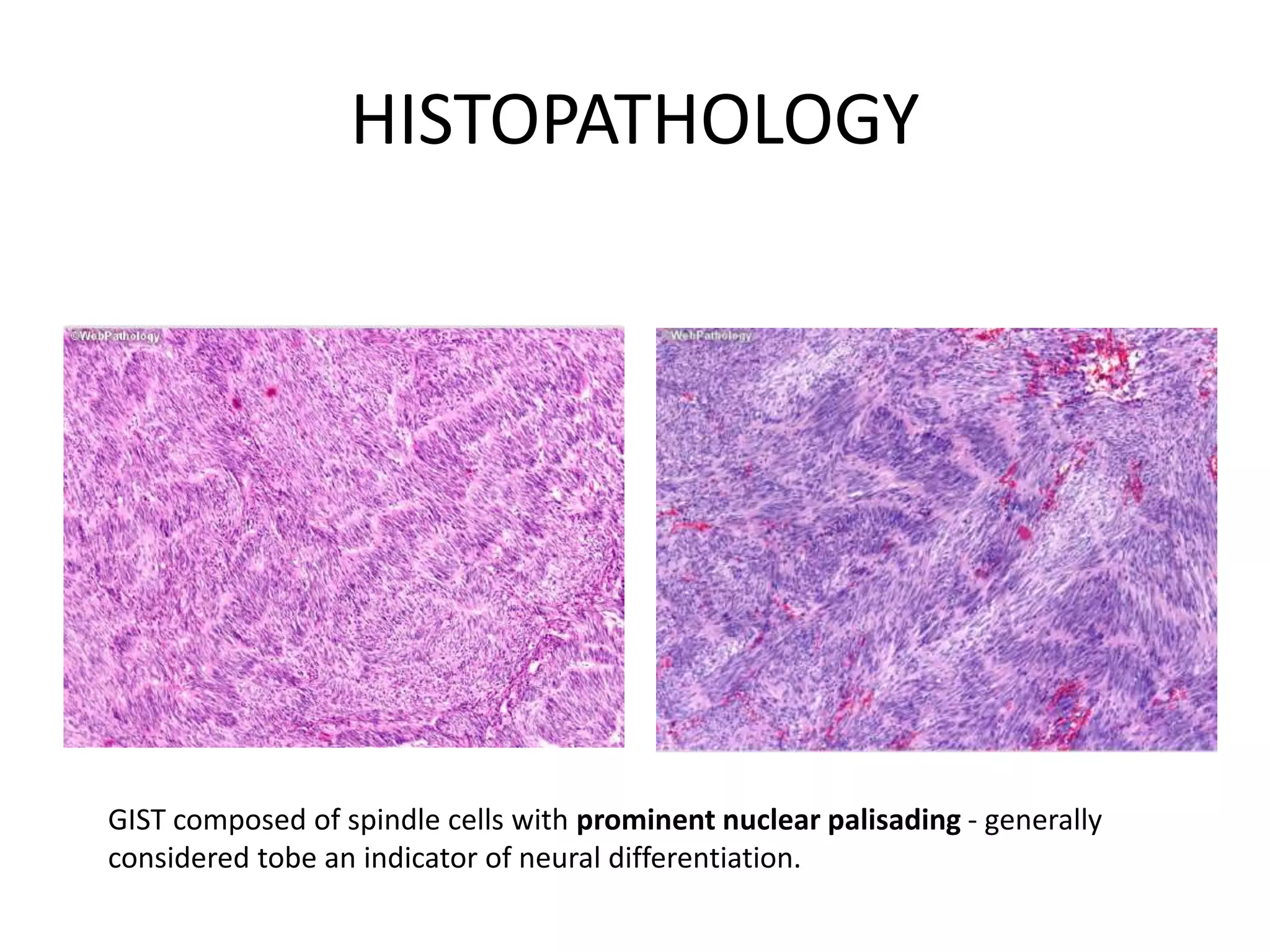 Gastrointestinal Stromal Tumors. | PPTX