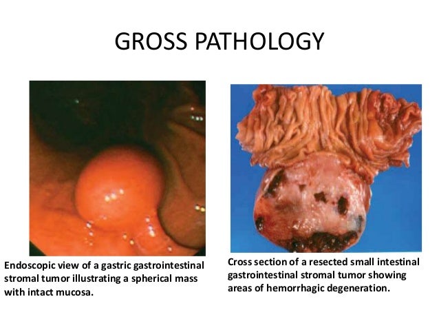 Gastrointestinal Stromal Tumors.