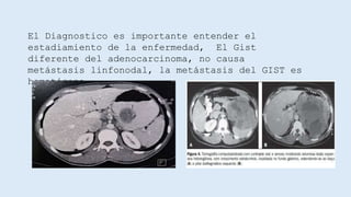 GIST- Tumores del estroma intestinal y estómago | PPTX
