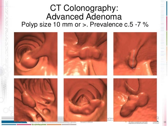 the latest in colorectal cancer research colon cancer mass size
