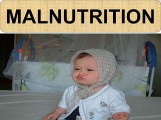 MALNUTRITION
 