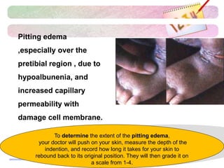 Pitting edema
,especially over the
pretibial region , due to
hypoalbunenia, and
increased capillary
permeability with
damage cell membrane.
To determine the extent of the pitting edema,
your doctor will push on your skin, measure the depth of the
indention, and record how long it takes for your skin to
rebound back to its original position. They will then grade it on
a scale from 1-4.
 