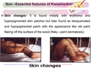 Non –Essential features of Kwashiorkor-
 Skin changes- It is found initially with erythema and
hyperpigmented skin patches but later found as desquamated
and hypopigmented patch with the appearance like old paint
flaking off the surface of the wood (flaky –paint dermatosis).
 