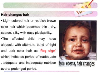 Hair changes-hair
• Light colored hair or reddish brown
color hair which becomes thin , dry,
coarse, silky with easy pluckability.
•The affected child may have
alopecia with alternate band of light
and dark color hair as ‘flag sign’
which indicates period of inadequate
, adequate and inadequate nutrition
over a prolonged period.
 