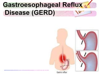Gastroesophageal Reflux
Disease (GERD)
 