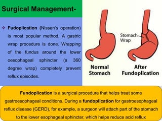Surgical Management-
 Fudoplication (Nissen’s operation)
is most popular method. A gastric
wrap procedure is done. Wrapping
of the fundus around the lower
oesophageal sphincter (a 360
degree wrap) completely prevent
reflux episodes.
Fundoplication is a surgical procedure that helps treat some
gastroesophageal conditions. During a fundoplication for gastroesophageal
reflux disease (GERD), for example, a surgeon will attach part of the stomach
to the lower esophageal sphincter, which helps reduce acid reflux
 
