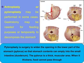  Antroplasty or
pyloroplasty may be
performed in some cases.
Gastrotomy may be
needed for feeding
purposes or temporarily to
decompress the stomach.
Pyloroplasty is surgery to widen the opening in the lower part of the
stomach (pylorus) so that stomach contents can empty into the small
intestine (duodenum). The pylorus is a thick, muscular area. When it
thickens, food cannot pass through
 
