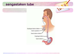 sengastaken tube
 