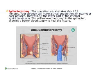 Copyright © 2022 Wolters Kluwer · All Rights Reserved
❖Sphincterotomy : The operation usually takes about 15
minutes. Your surgeon will make a small cut on the skin near your
back passage. They will cut the lower part of the internal
sphincter muscle. This will relieve the spasm in the sphincter,
allowing a better blood supply to heal the fissure.
 