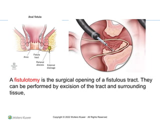 Copyright © 2022 Wolters Kluwer · All Rights Reserved
A fistulotomy is the surgical opening of a fistulous tract. They
can be performed by excision of the tract and surrounding
tissue,
 