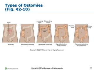 Copyright © 2022 Wolters Kluwer · All Rights Reserved
Types of Ostomies
(Fig. 42-10)
Copyright © 2020 by Elsevier, Inc. All rights reserved. 35
 