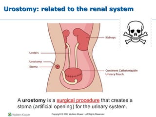 Copyright © 2022 Wolters Kluwer · All Rights Reserved
Urostomy: related to the renal system
A urostomy is a surgical procedure that creates a
stoma (artificial opening) for the urinary system.
 