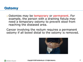 Copyright © 2022 Wolters Kluwer · All Rights Reserved
o Ostomies may be temporary or permanent. For
example, the person with a draining fistula may
need a temporary ostomy to prevent stool from
reaching the diseased area.
Cancer involving the rectum requires a permanent
ostomy if all bowel distal to the ostomy is removed.
Ostomy
Copyright © 2020 by Elsevier, Inc. All rights reserved. 37
 