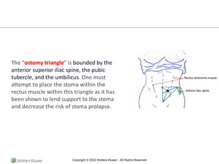 Copyright © 2022 Wolters Kluwer · All Rights Reserved
The “ostomy triangle” is bounded by the
anterior superior iliac spine, the pubic
tubercle, and the umbilicus. One must
attempt to place the stoma within the
rectus muscle within this triangle as it has
been shown to lend support to the stoma
and decrease the risk of stoma prolapse.
 