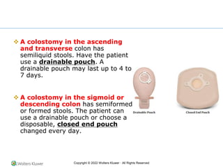 Copyright © 2022 Wolters Kluwer · All Rights Reserved
❖ A colostomy in the ascending
and transverse colon has
semiliquid stools. Have the patient
use a drainable pouch. A
drainable pouch may last up to 4 to
7 days.
❖ A colostomy in the sigmoid or
descending colon has semiformed
or formed stools. The patient can
use a drainable pouch or choose a
disposable, closed end pouch
changed every day.
 