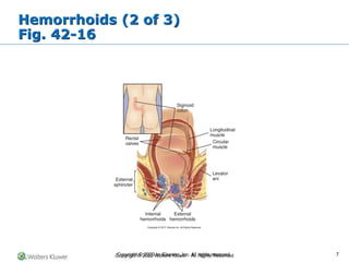 Copyright © 2022 Wolters Kluwer · All Rights Reserved
Hemorrhoids (2 of 3)
Fig. 42-16
Copyright © 2020 by Elsevier, Inc. All rights reserved. 7
 