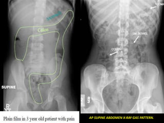 AP SUPINE ABDOMEN X-RAY GAS PATTERN.
 