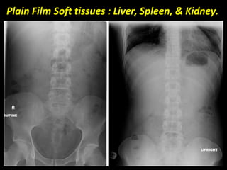 Plain Film Soft tissues : Liver, Spleen, & Kidney.
 
