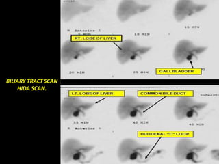BILIARY TRACT SCAN
HIDA SCAN.
 