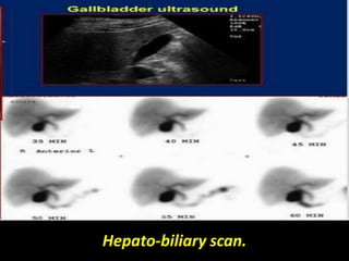 Hepato-biliary scan.
 
