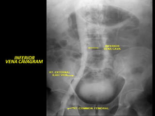 INFERIOR
VENA CAVAGRAM
 