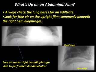 What’s Up on an Abdominal Film?
• Always check the lung bases for an infiltrate.
•Look for free air on the upright film: commonly beneath
the right hemidiaphragm.
Free air under right hemidiaphragm
due to perforated duodenal ulcer
Diaphragm
Liver edge
 