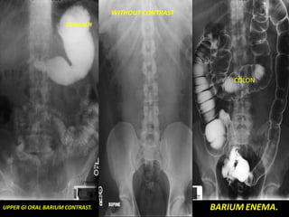 WITHOUT CONTRAST
STOMACH
COLON
UPPER GI ORAL BARIUM CONTRAST. BARIUM ENEMA.
 