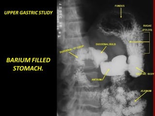 UPPER GASTRIC STUDY
BARIUM FILLED
STOMACH.
 
