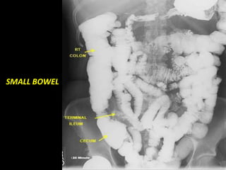 SMALL BOWEL
 