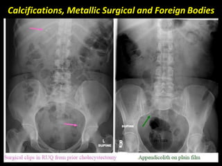 Calcifications, Metallic Surgical and Foreign Bodies
 