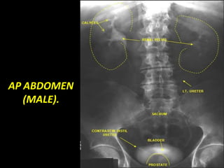 AP ABDOMEN
(MALE).
 