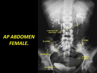 AP ABDOMEN
FEMALE.
 