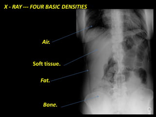 X - RAY --- FOUR BASIC DENSITIES
Air.
Soft tissue.
Fat.
Bone.
 