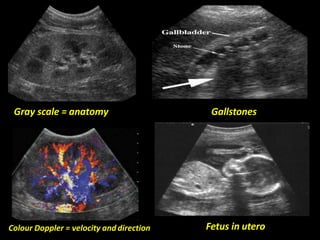 Gray scale = anatomy Gallstones
Fetus in uteroColour Doppler = velocity anddirection
 