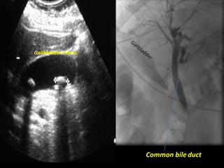 Common bile duct
Gallbladder stones.
 