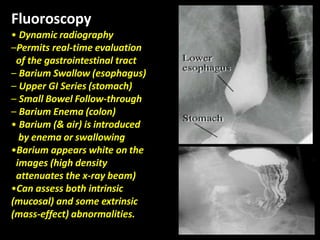 Fluoroscopy
• Dynamic radiography
–Permits real-time evaluation
of the gastrointestinal tract
– Barium Swallow (esophagus)
– Upper GI Series (stomach)
– Small Bowel Follow-through
– Barium Enema (colon)
• Barium (& air) is introduced
by enema or swallowing
•Barium appears white on the
images (high density
attenuates the x-ray beam)
•Can assess both intrinsic
(mucosal) and some extrinsic
(mass-effect) abnormalities.
 
