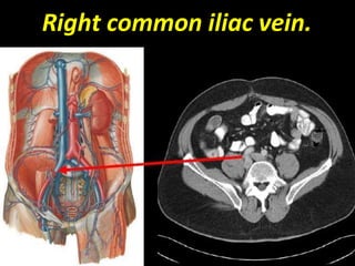 Right common iliac vein.
 