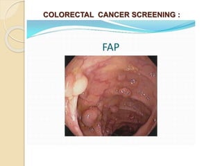COLORECTAL CANCER SCREENING :
 
