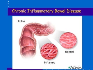 Chronic Inflammatory Bowel Disease 
