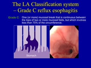 The LA Classification system – Grade C reflux esophagitis Stomach Grade C : One (or more) mucosal break that is continuous between the tops of two or more mucosal folds, but which involves less than 75% of the circumference. 