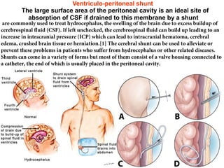 Ventriculo-peritoneal shunt
The large surface area of the peritoneal cavity is an ideal site of
absorption of CSF if drained to this membrane by a shunt
are commonly used to treat hydrocephalus, the swelling of the brain due to excess buildup of
cerebrospinal fluid (CSF). If left unchecked, the cerebrospinal fluid can build up leading to an
increase in intracranial pressure (ICP) which can lead to intracranial hematoma, cerebral
edema, crushed brain tissue or herniation.[1] The cerebral shunt can be used to alleviate or
prevent these problems in patients who suffer from hydrocephalus or other related diseases.
Shunts can come in a variety of forms but most of them consist of a valve housing connected to
a catheter, the end of which is usually placed in the peritoneal cavity.
 