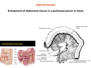 Internal hernias
Entrapment of abdominal viscus in a peritoneal pouch or fossa
 