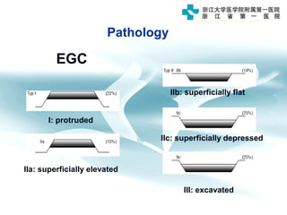 EGC
Pathology
I: protruded
IIa: superficially elevated
IIc: superficially depressed
IIb: superficially flat
III: excavated
 