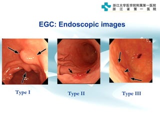 EGC: Endoscopic images
Type I Type II Type III
 